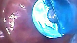 Endoscope POV: Test Tube Cock Urethral Insertion