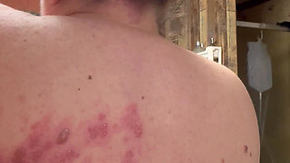 Bad Case of Shingles